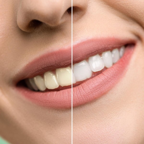 отбеливание зубов