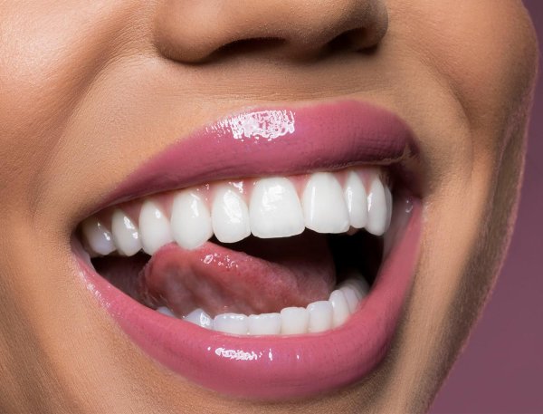 голливудская улыбка виниры