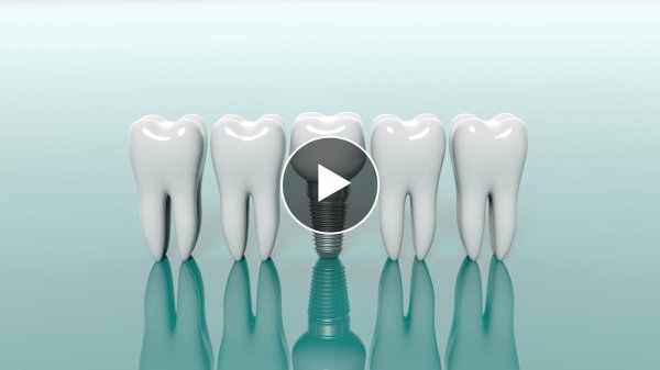 дентальные импланты