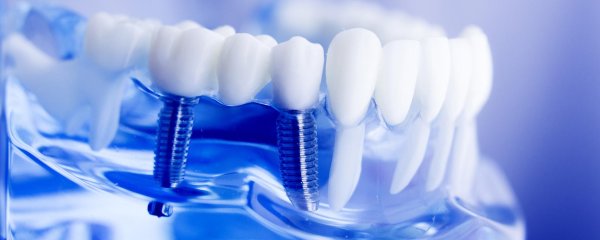 импланты зубов виды