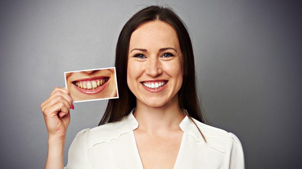 отбеливание зубов