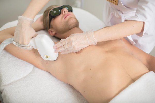 лазерная депиляция