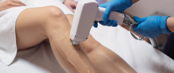 лазерной эпиляции