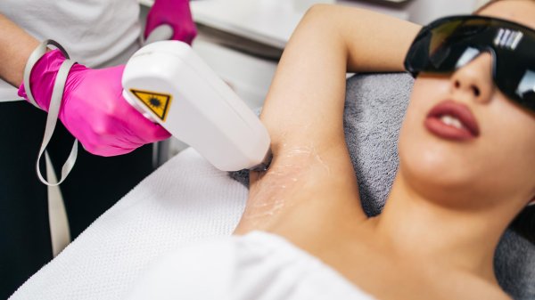 лазерная депиляция