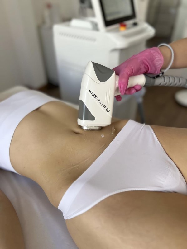 эпиляция диодным лазером