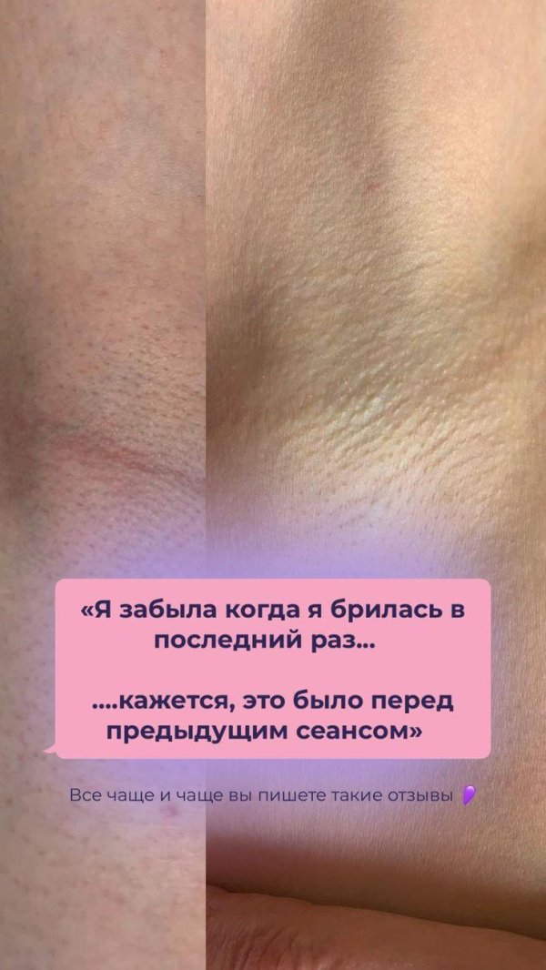 восковая депиляция