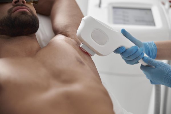 лазерная депиляция для мужчин