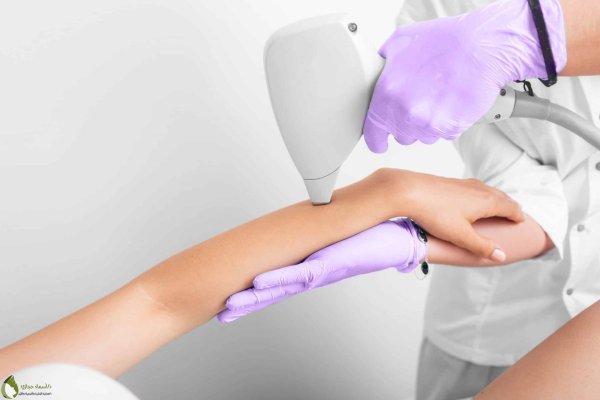 лазерная депиляция