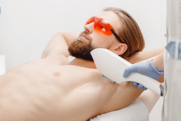 лазерная депиляция