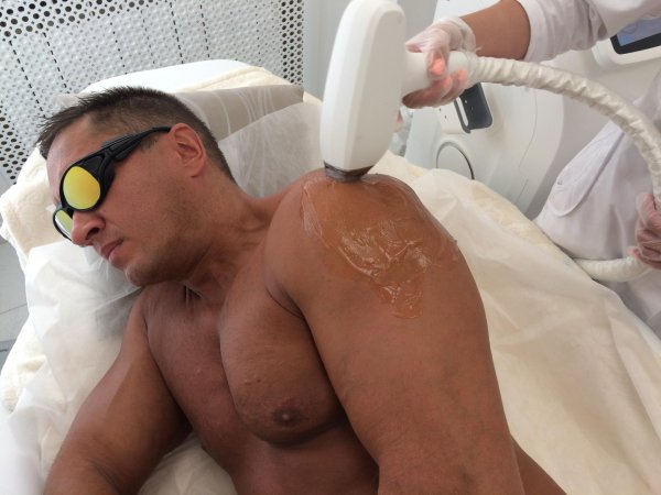 мужская эпиляция