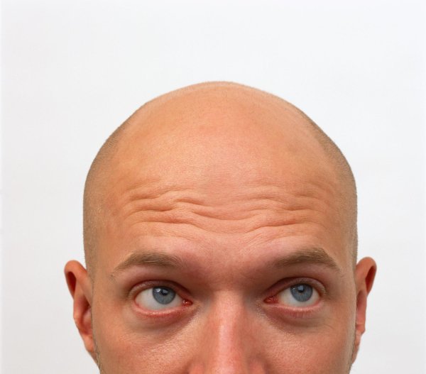 лысина сверху