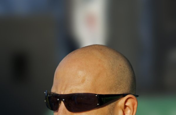 трихопигментация очаговая алопеция