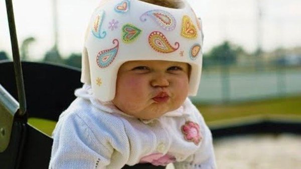 шлем для выравнивания головы у ребенка