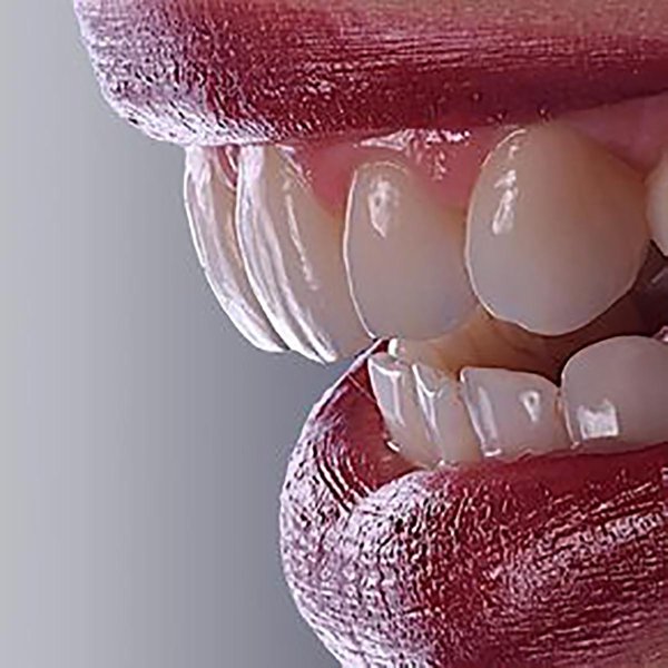 керамические виниры