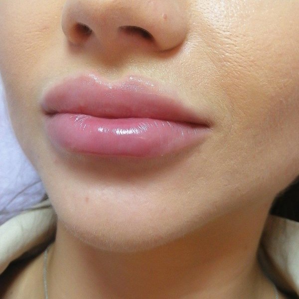 увеличение губ